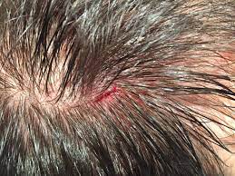 Heridas