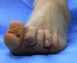A bone spur may be caused by degenerative arthritis or tendonitis. Rheumatoid Arthritis Of The Foot And Ankle Orthoinfo Aaos