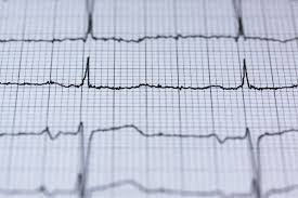 Rafael cardoso passa por cirurgia para implantar desfibrilador cardíaco. Com O Azure Mapeamento De Desfibriladores Cardiacos Do Reino Unido Pode Salvar Milhares De Vidas Microsoft News Center Brasil