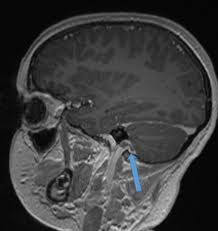 Image result for Mastoiditis