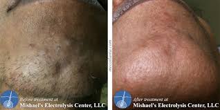 The results weren't exactly what i was expecting. Before After Electrolysis Hair Removal Mishael S Electrolysis Center
