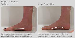 Morton S Neuroma Non Surgical Natural Treatment