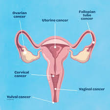 Symptoms often do not begin until the cancer becomes larger and when this happens, the most common symptoms are: What Is Gynaecological Cancer And What Are The Symptoms Queensland Health