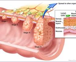 Image result for Colorectal Cancer