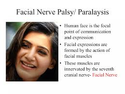 Facial nerve palsy