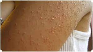 5 Ways To Get Rid Of Keratosis Pilaris Allergies Seasonal Allergies Symptoms Digestive Health Digestive Health Skin Cure Strawberry Legs Keratosis Pilaris
