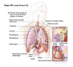 But lung cancer also occurs in people who never smoked and in those who never had prolonged exposure to. Definition Of Stage Iiib Non Small Cell Lung Cancer Nci Dictionary Of Cancer Terms National Cancer Institute
