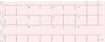 Implantable Cardioverter-Defibrillator Shocks And Nonsustained Rapid  Ventricular Rhythms | Netherlands Heart Journal