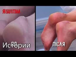 как лечить косточку на ноге в домашних условиях отзывы Natalyu Kononovich Izbavili Ot Zagadochnyh Narostov Na Nogah Youtube