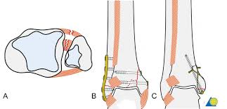 Although a medial malleolus fracture can be a serious injury, the outlook for recovery is good, and complications are rare. Orthoforum Sprunggelenksfraktur