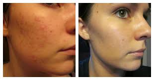 Bio Oil Before After Acne Scars Pin On Bio Oil Results