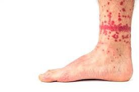 Some individuals are simply not allergic to fleabites. Fleabites Symptoms Causes Risks And Treatment