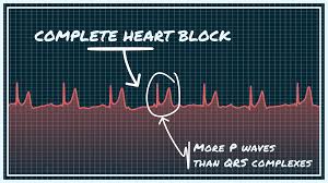 Image result for Atrioventricular Block