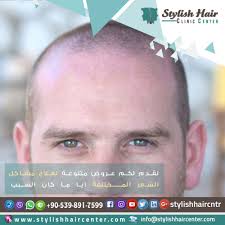 تعاني تساقط الشعر بشكل ملحوظ الآن نوظف تقنيات الطب الحديثة في كافة عمليات زراعة الشعر لجميع الحالات بلا استثناء تقنية الاقت Hair Clinic Stylish Hair Clinic