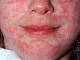 Image result for Rubella