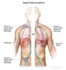 Non Hodgkin Lymphoma Hematology Oncology Associates Of Cny