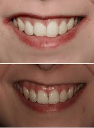 Misaligned teeth, crooked teeth or crowded teeth are commonly seen in kids, adults and old people. Straighten Teeth Gateshead Cosmetic Braces Orthodontics Newcastle