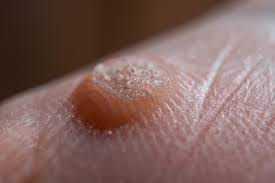Feigwarzen (spitze kondylome, condylomata acuminata) sind gutartige hautwucherungen im intimbereich. Warzen Hpv Krebs Dr Retzek S Umfassend Gesund