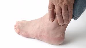 Image result for gout symptoms toe
