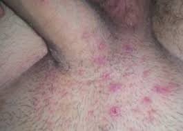 They can appear anywhere on your body where you can grow hair. How To Get Rid Of Ingrown Hairs On My Testicles