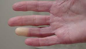 Lupus is an autoimmune disease—a disorder in which the body's immune system attacks the body's own cells and organs. Raynaud S Phenomenon Johns Hopkins Medicine