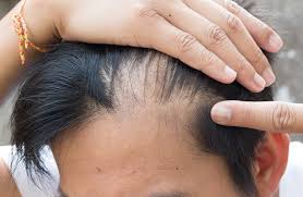 It reaches 4 out of 5 men by age 70. How Much Hair Loss Is Normal A Guide For Young Gents The Bald Gent