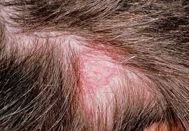 Medical experts weigh in on recent research. Tinea Capitis Vs Seborrheic Dermatitis Ds Healthcare Group