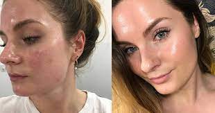 How to get rid of red spots on skin? How To Treat Broken Capillaries On The Face Popsugar Beauty