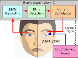 Figure 1 from Closed-loop eyelid reanimation system with real-time blink  detection and electrochemical stimulation for facial nerve paralysis