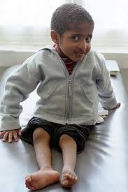 Image result for Polio