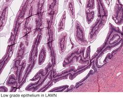 Pathology Outlines Lamn And Hamn Mucinous Neoplasms
