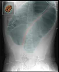 Image result for Sigmoid Volvulus