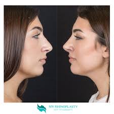 👃 Alessia, 𝗿𝗶𝗻𝗼𝘀𝗲𝘁𝘁𝗼𝗽𝗹𝗮𝘀𝘁𝗶𝗰𝗮 𝘀𝗲𝗰𝗼𝗻𝗱𝗮𝗿𝗶𝗮. 🔎 Non  esiste un numero massimo di interventi di rinoplastica che si possono  effettuare. Le rinoplastiche di revisione possono essere eseguite dal  chirurgo numerose volte, ma è importante