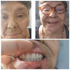 Prótese total e um sorriso maravilhoso.