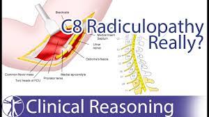 Ulnar Nerve Entrapment Mimicking C8 Radiculopathy Youtube