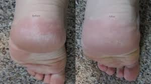 «we're showing you how you could use listerine as a foot soak on the blog today! The Vinegar And Listerine Foot Bath Test Em Lustrous Lacquer Em