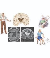 Image result for Chorea