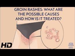 Image result for sore skin in the groin area