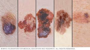 slide show melanoma pictures to help identify skin cancer