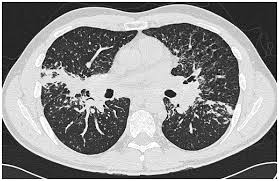 Review of literature and proposal of new diagnostic and classification criteria. Jof Free Full Text Chronic Pulmonary Aspergillosis Where Are We And Where Are We Going Html