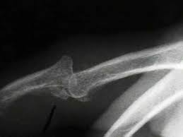 Image result for Lateral PIP Dislocation