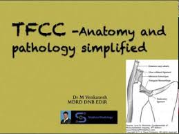 The triangular fibrocartilage complex (tfcc) is a network of ligaments, tendons, and cartilage in the wrist. Tfcc Triangular Fibrocartilage Complex Youtube