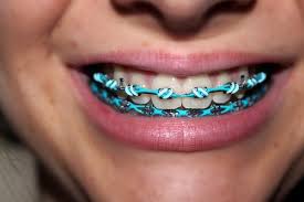 Girls With Braces Customizing Your Braces Cool And Colorful Designs For Girls With Braces Braces Colors Teeth Braces Braces Bands