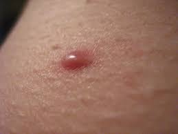 Ingrown hairs usually result from frequent and close shaving or wearing tight clothing that chafes against the skin. Pimple Or Ingrown Hair A Photo On Flickriver