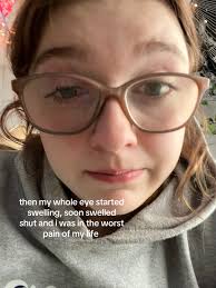 What Happened to Burns Eye