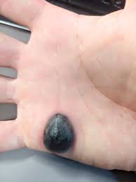 This removal method may require 1 to 5 procedures for its full effectiveness to be seen. 1075 Best Wart Images On Pholder Warts Trypophobia And Dermatology