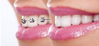 Like our facebook or follow our instagram page 2. How Braces Work In 5 Simple Steps
