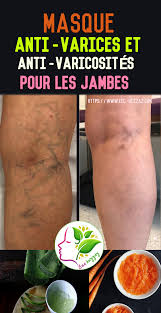Epingle Sur Traiter Les Varices