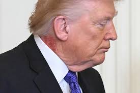 Trump’s Doctor Says Visible Neck Irritation Is From Skin Treatment