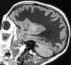 Schilder´s disease is a primary demyelinating disease of childhood and is considered by some to represent childhood multiple sclerosis. Leukoencephalopathy With Vanishing White Matter An Overview Sciencedirect Topics